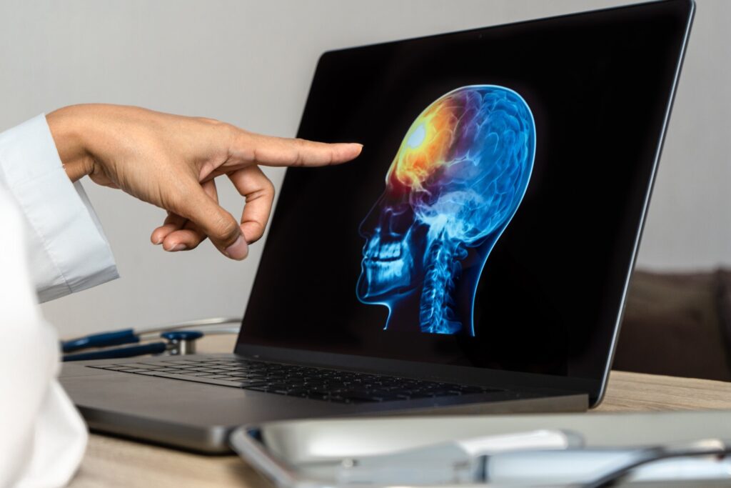 Medical professional analyzing a brain scan on a laptop to calculate a TBI settlement in Pennsylvania.